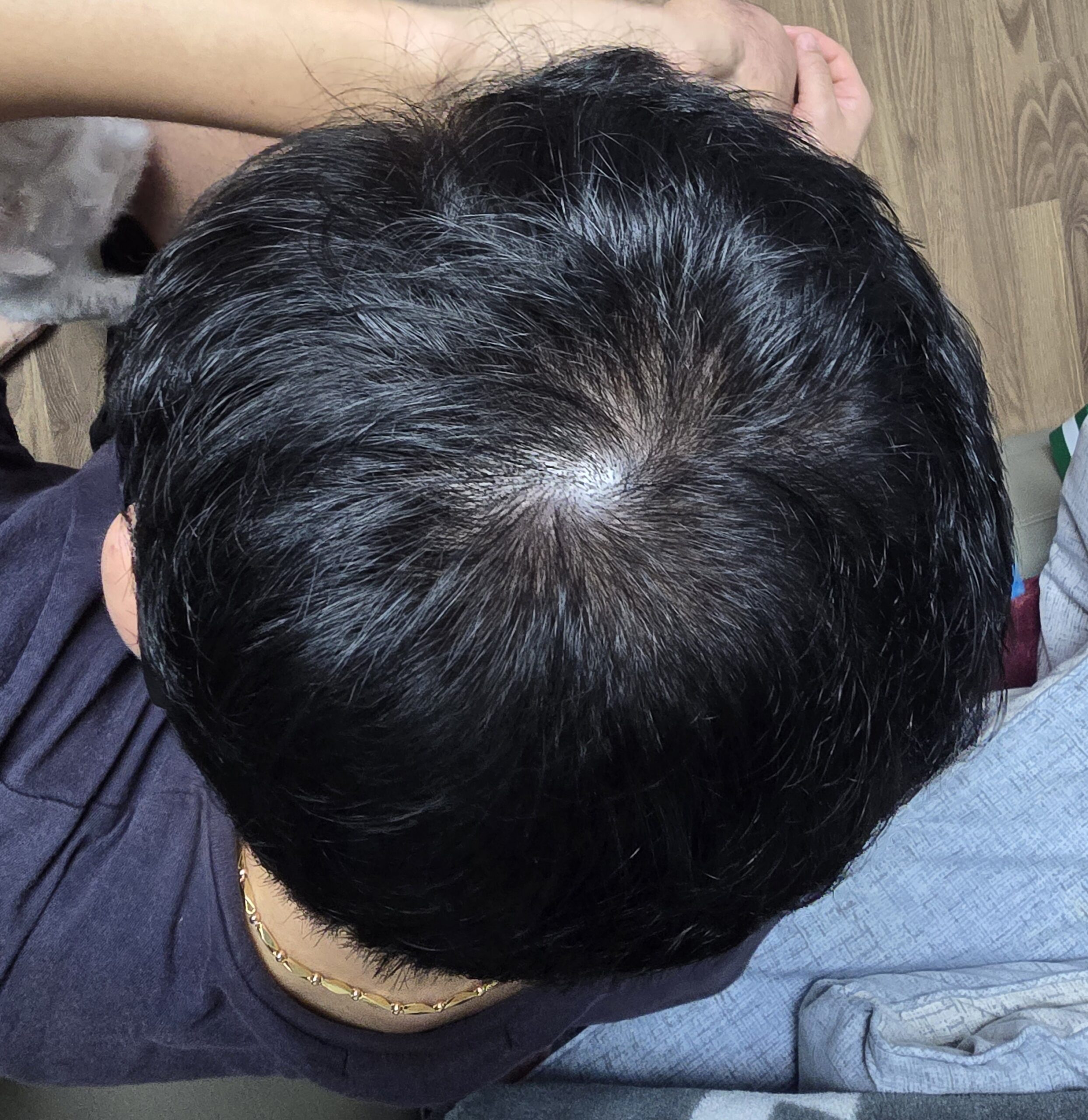 부산 망미 자혜내과 탈모 치료 후기 | 6개월 복용 효과와 비용 총정리